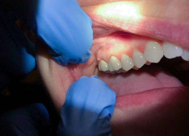 Best Emergency Gum Treatment in Wills Point, TX